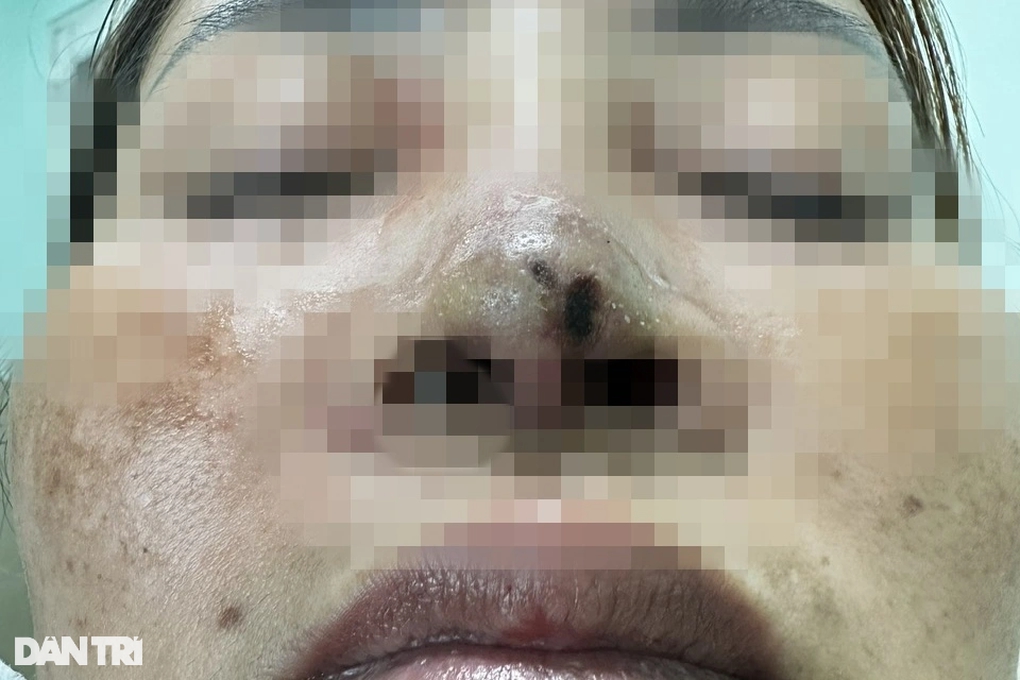 Mẹ 2 con hoại tử, co giật ở bến xe sau khi vào viện sắc đẹp ở TPHCM sửa mũi - Ảnh 1.