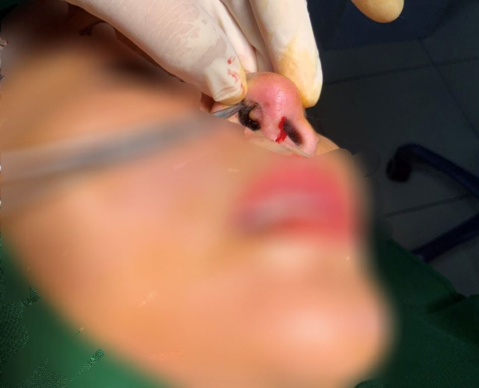 Huế: Mũi bị biến dạng sau phẫu thuật, người phụ nữ gửi đơn tố cáo thẩm mỹ viện - Ảnh 2.