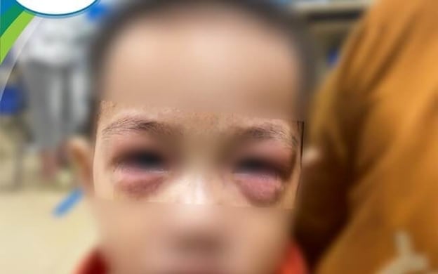Cảnh báo nhiều trẻ bị đau mắt đỏ, nhiều cha mẹ phải loay hoay nghỉ làm ở nhà chăm con - Ảnh 1.
