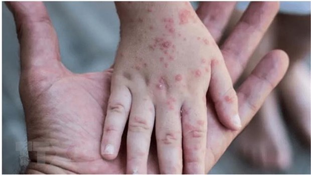 Viện Pasteur TP.HCM nói gì về hai ca đậu mùa khỉ chưa rõ nguồn lây? - Ảnh 3.