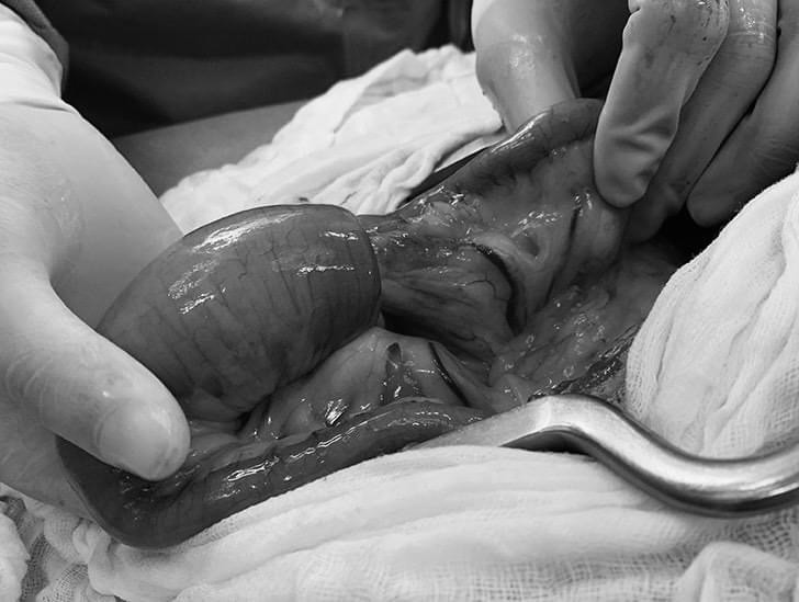 Trẻ đau bụng, khóc từng cơn coi chừng lồng ruột cấp tính - Ảnh 1.