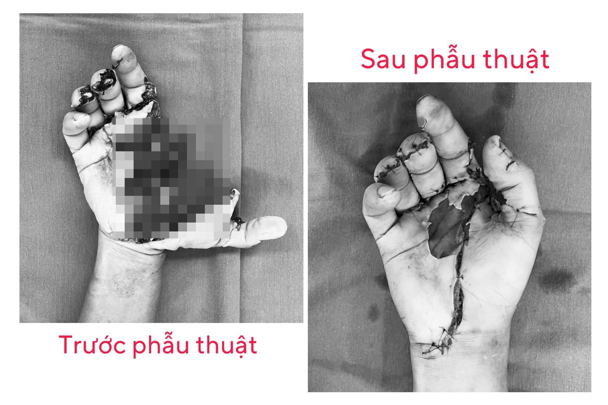 Nhiều thanh niên nát tay, rách mắt vì tai nạn pháo nổ dịp Tết Giáp Thìn- Ảnh 1.