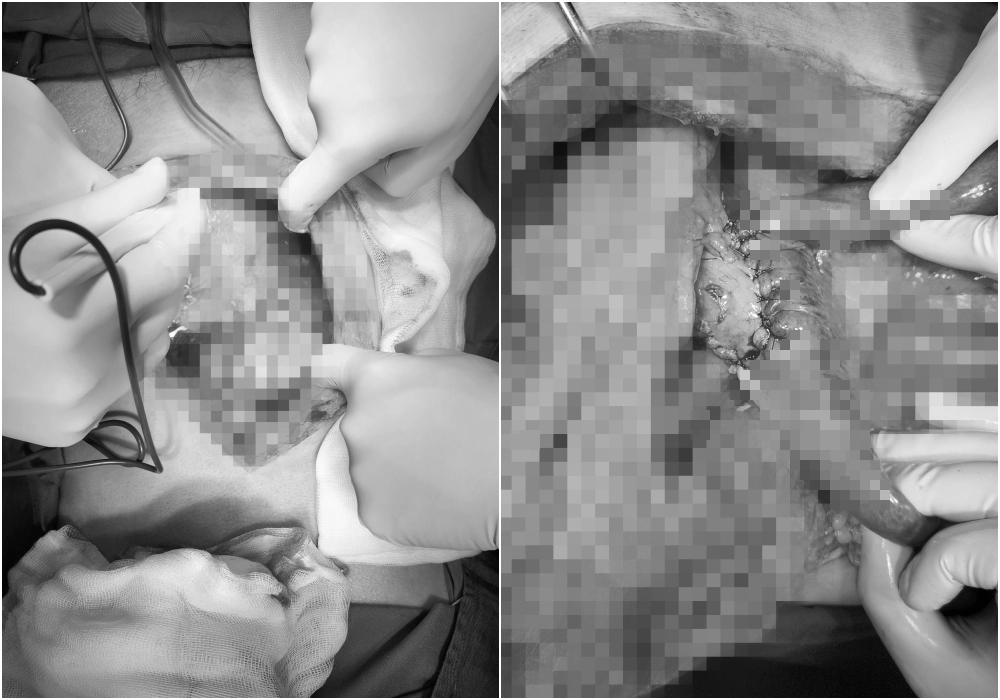 Ca mổ "2 năm" cứu sống bệnh nhân vỡ gan, vỡ dạ dày vì tai nạn- Ảnh 1.