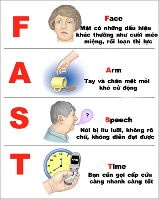 "6 cần, 3 không" khi có người nghi ngờ đột quỵ để cứu tính mạng- Ảnh 2.