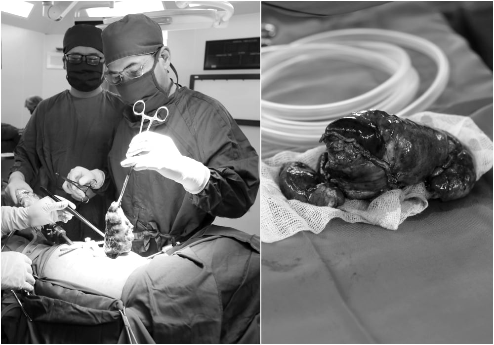 Điều trị viêm phổi vô tình phát hiện "phổi thừa" - Ảnh 2.