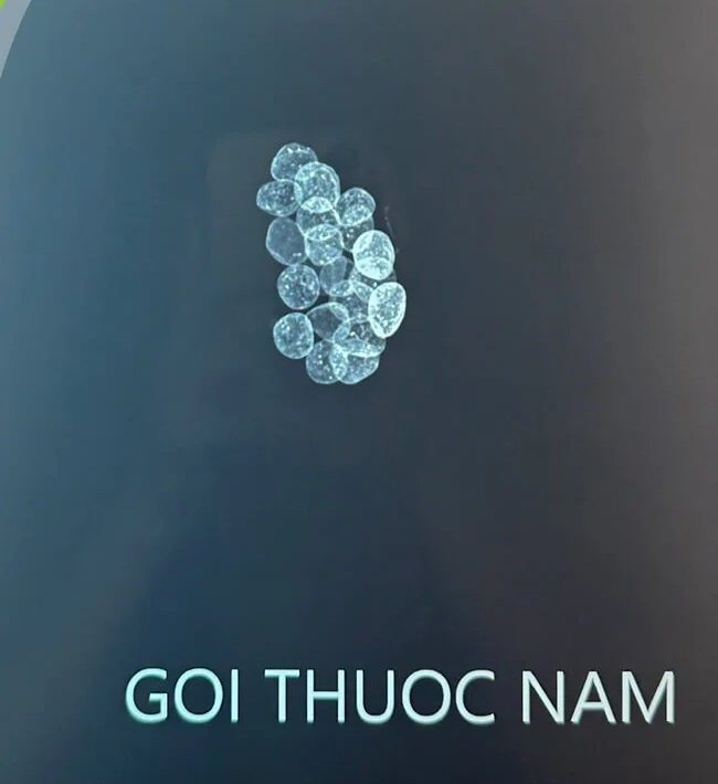 Nguy kịch vì ngộ độc chì sau khi uống thuốc nam không rõ nguồn gốc- Ảnh 2.