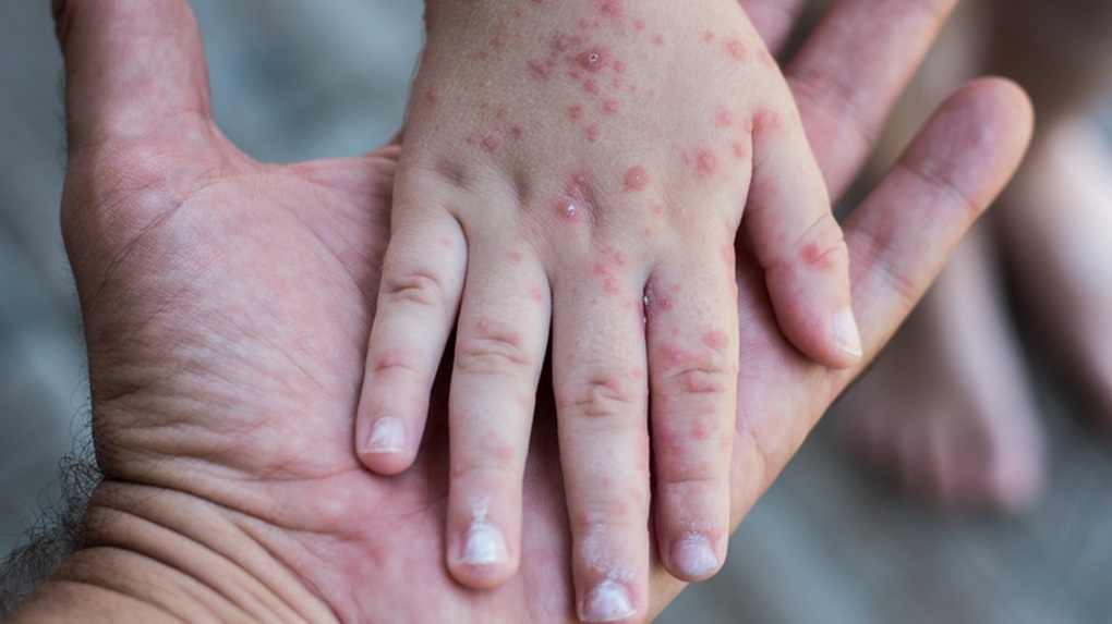 Hà Nội xuất hiện ca mắc rubella đầu tiên trong năm, bác sĩ cảnh báo có thể thành dịch lớn- Ảnh 1.