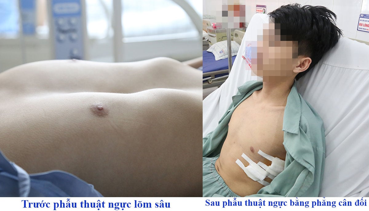 Lõm ngực bẩm sinh, thiếu niên 16 tuổi tự ti, yếu ớt- Ảnh 1.