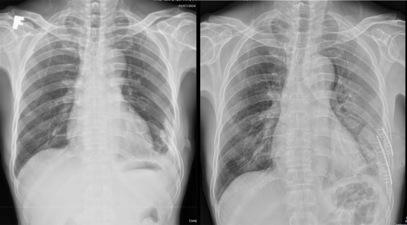 Nẹp vít cứu sống bệnh nhân chấn thương, gãy nhiều xương sườn - Ảnh 2.