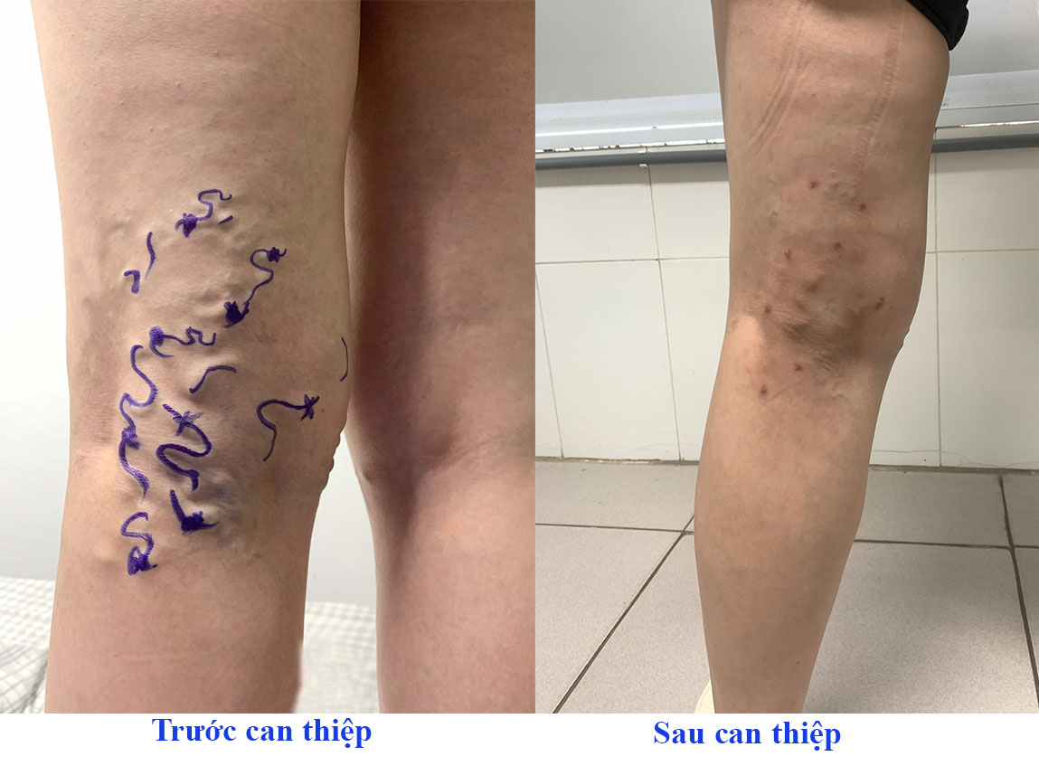 Cứu đôi chân "nổi giun" ngoằn nghèo xấu xí và đau nhức- Ảnh 2.