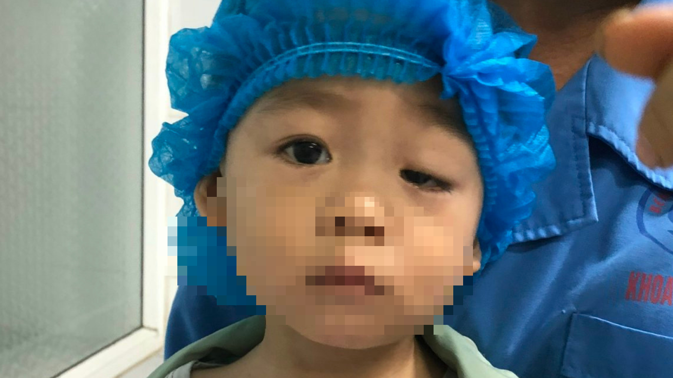 "Cứu cánh" cho những trẻ bị sụp mi bẩm sinh- Ảnh 1.