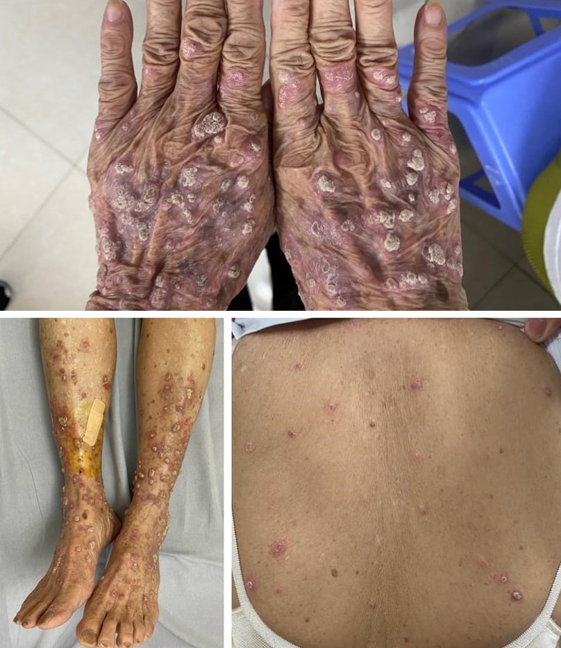 Bỗng nhiên nổi "hạt cơm" toàn thân vì bệnh hiếm gặp- Ảnh 1.