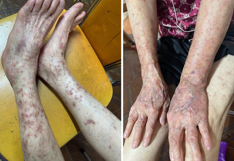 Bỗng nhiên nổi "hạt cơm" toàn thân vì bệnh hiếm gặp- Ảnh 2.