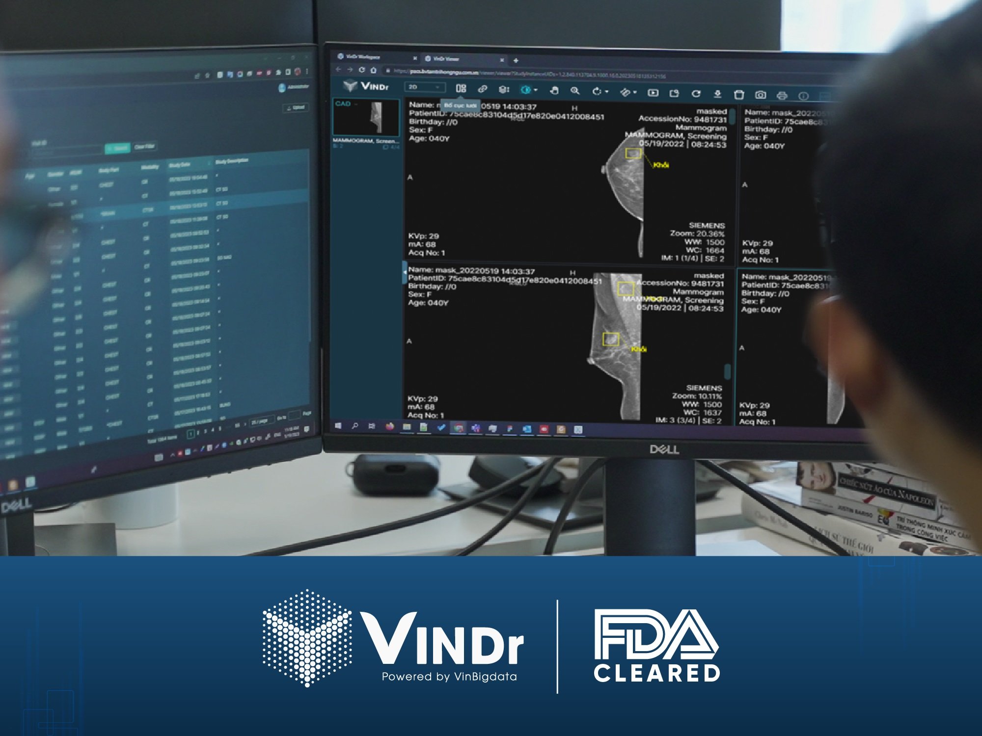 "Tấm vé" FDA sẽ giúp các sản phẩm AI chẩn đoán ảnh y tế Việt Nam tiến ra toàn cầu, hỗ trợ đắc lực cho y bác sĩ.