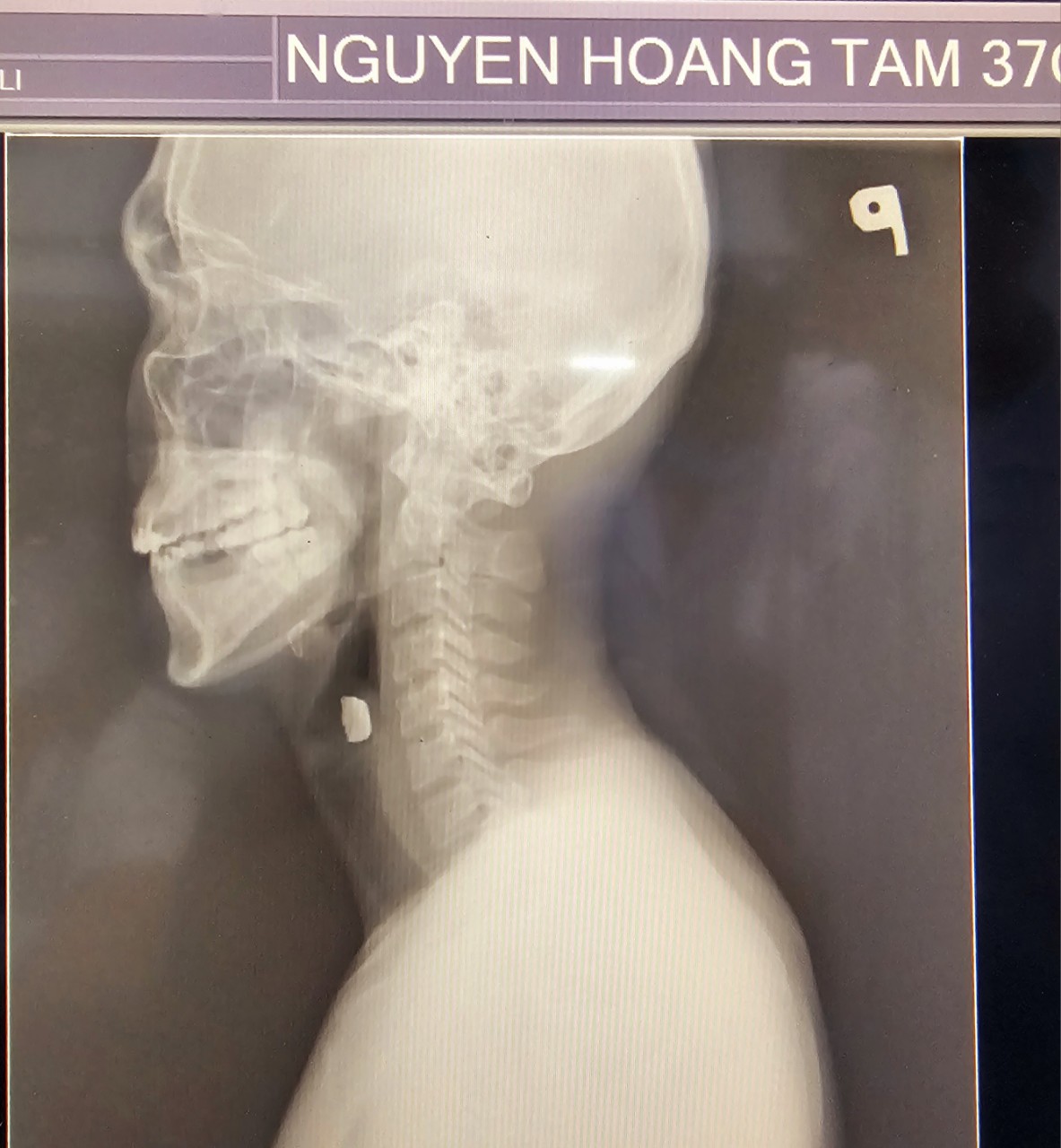 Cuốc đất trúng viên đạn phát nổ, mảnh đạn bay đứt mạch máu cổ- Ảnh 1.