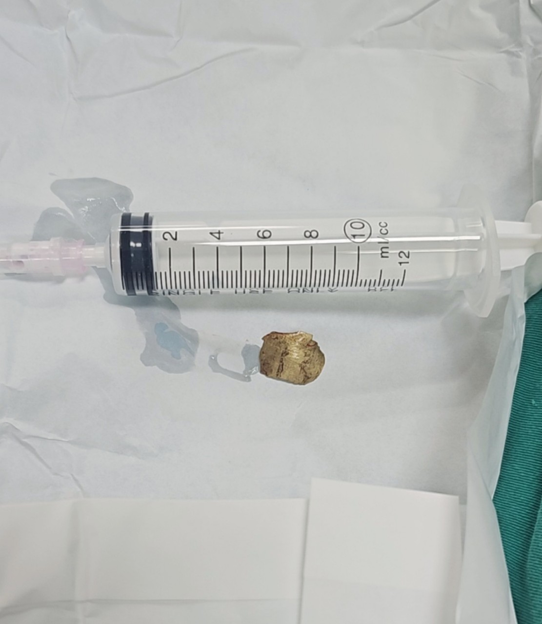 Cuốc đất trúng viên đạn phát nổ, mảnh đạn bay đứt mạch máu cổ- Ảnh 2.