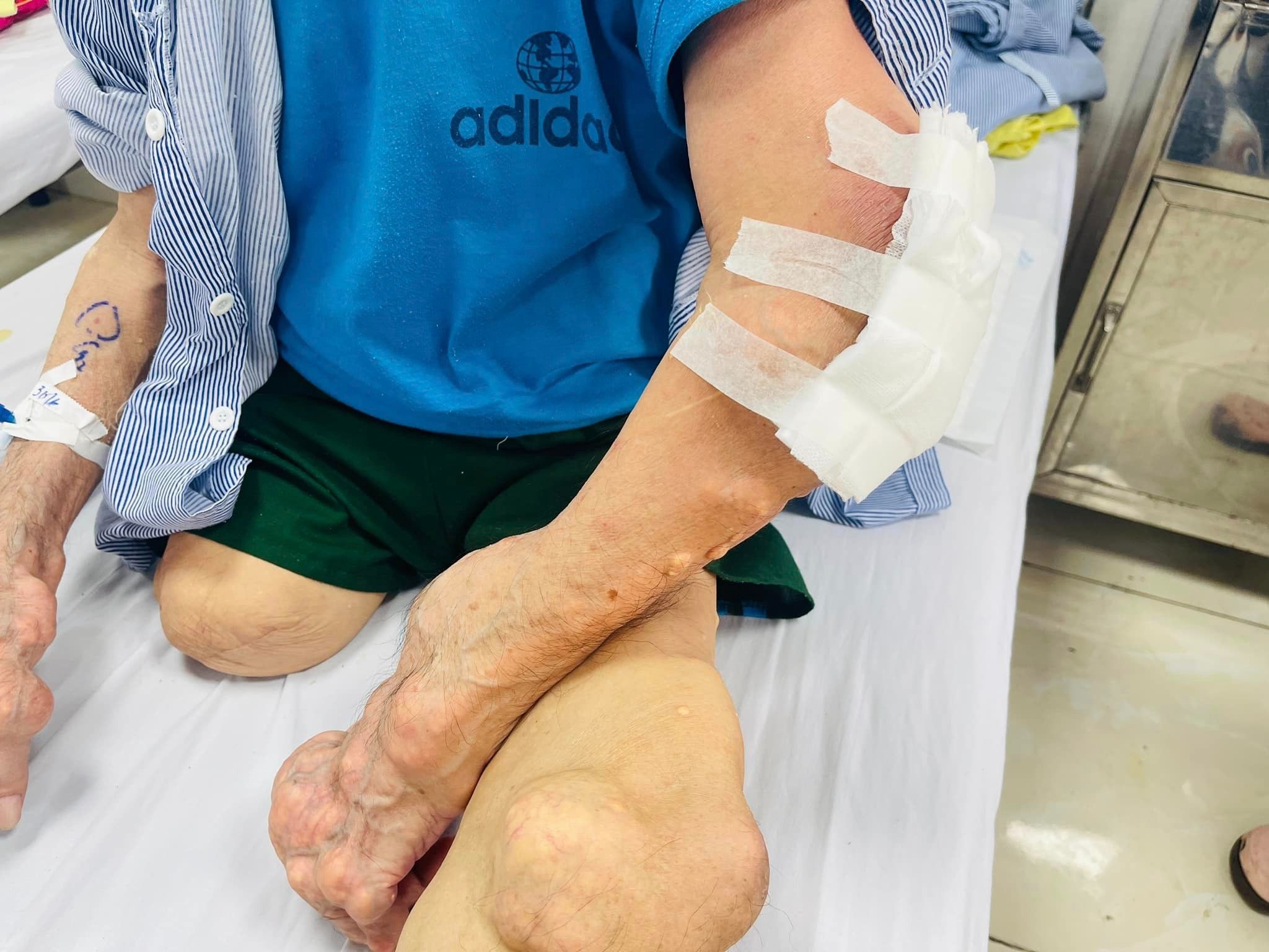 Sửng sốt với đôi tay biến dạng, u cục lồi lõm do gout nặng- Ảnh 3.