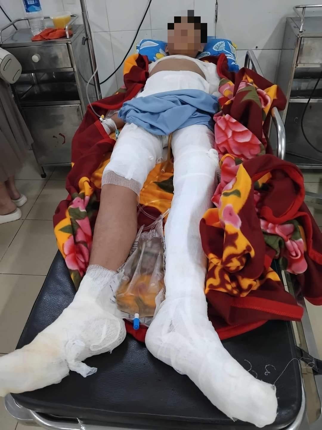 Bé 11 tuổi bị bỏng điện nặng khi cần câu vướng vào đường dây cao thế- Ảnh 1.