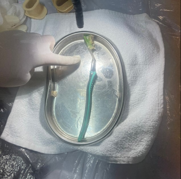 Vô tình nuốt cả bàn chải đánh răng vào bụng - Ảnh 1.