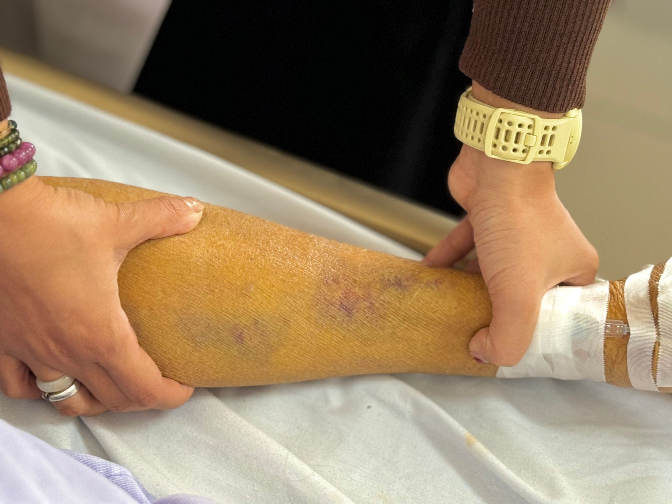 Hốt hoảng vì làn da như "sát nghệ" của bệnh nhân tự ý ngừng thuốc  - Ảnh 2.