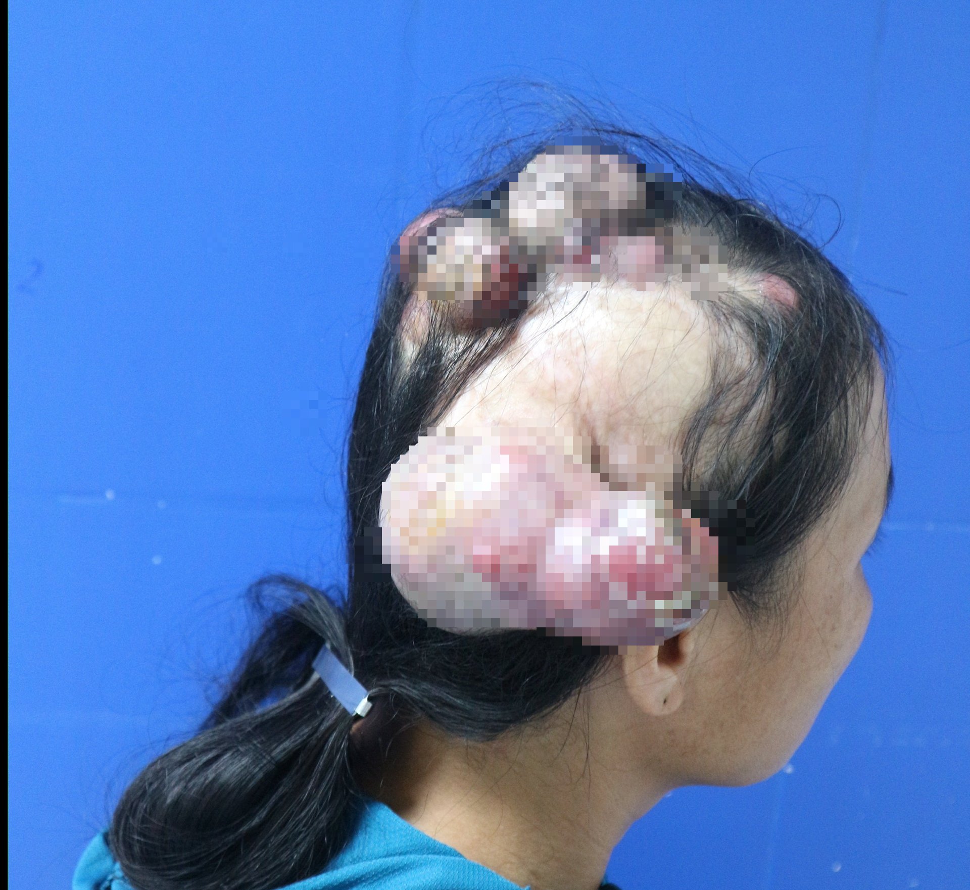 12 giờ ‘cân não’, bác sĩ mang lại dung nhan mới cho người phụ nữ dân tộc bị ung thư da đầu - Ảnh 1.