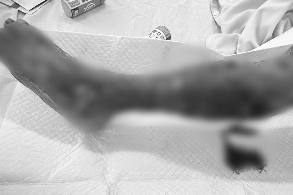 Người đàn ông lái tàu biển suýt phải cắt bỏ chân vì "vi khuẩn ăn thịt người" - Ảnh 1.