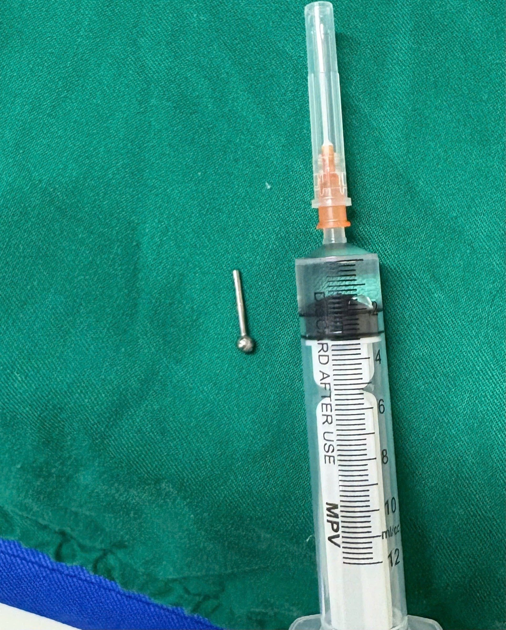 Nuốt chửng khuyên lưỡi, cô gái phải chịu 90 phút bơm nước vào dạ dày - Ảnh 2.