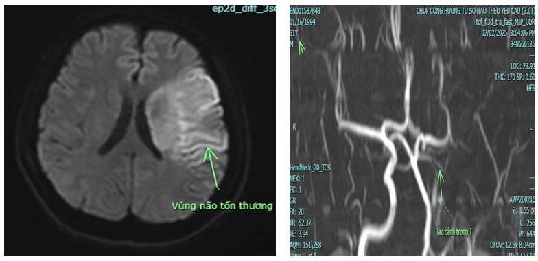 Nam thanh niên 21 tuổi bỗng liệt nửa người vì bệnh "người già" - Ảnh 2.