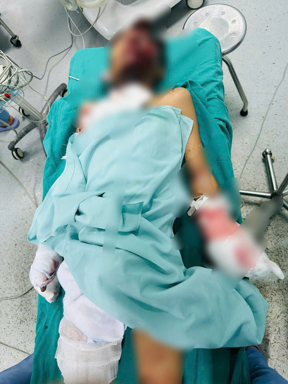 Chế tạo pháo, một học sinh bị pháo nổ nát bàn tay và tổn thương vùng mặt - Ảnh 2.