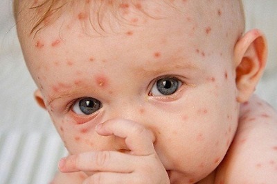 Bùng phát dịch sởi tại Mỹ, CDC ban bố cảnh báo đi lại - Ảnh 1.