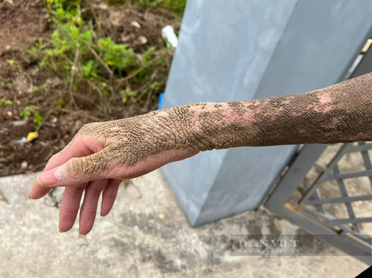 Cậu bé mồ côi cha mang căn bệnh kỳ lạ, da xù xì như thân cây - Ảnh 5.