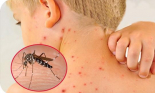 Dịch sốt xuất huyết nóng từng ngày, các địa phương 'khóc ròng' vì thiếu thuốc
