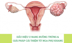 Dấu hiệu u nang buồng trứng và giải pháp cải thiện hiệu quả từ Nga Phụ Khang