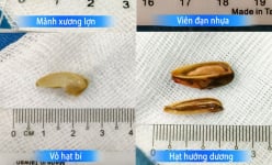 Hóc dị vật đường thở 'muôn hình vạn trạng' ở trẻ em