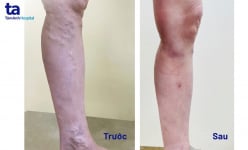 Bệnh viện Tâm Anh điều trị hiệu quả suy giãn tĩnh mạch chân cho bệnh nhân bằng phương pháp Laser nội mạch