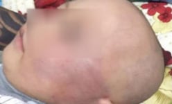 Vĩnh Long: Vì khóc, bé 19 tháng tuổi bị bảo mẫu đánh sưng đỏ