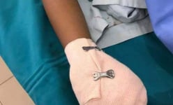 Pin dự phòng phát nổ, người đàn ông vỡ toác mu bàn tay